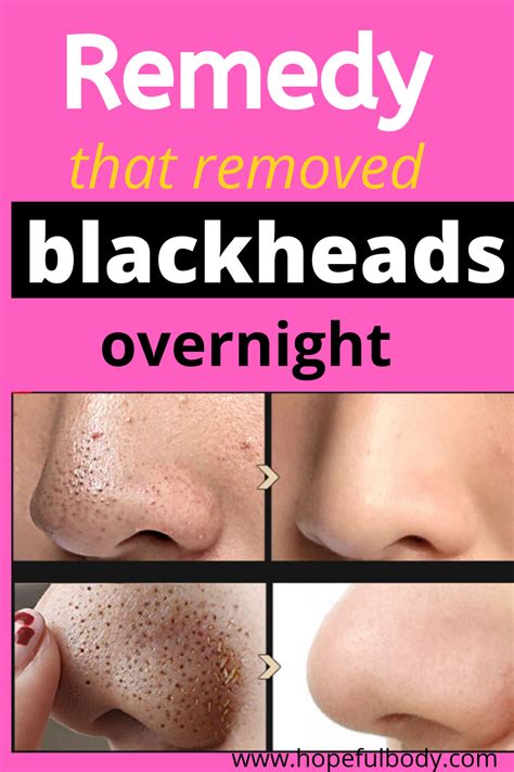 How To Get Rid Of Blackheads On Your Nose Overnight Trick In Get