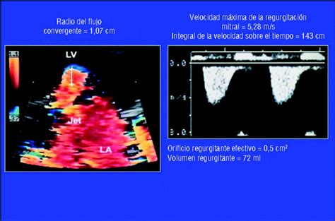 Papel de la ecocardiografía en la detección y el pronóstico de la