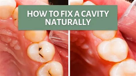 how to fix a cavity naturally