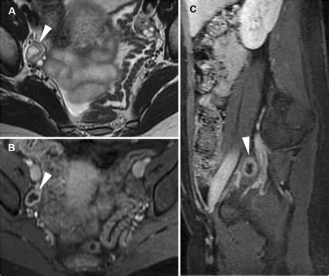 Cross Sectional Imaging Of Acute Gynaecologic Disorders Ct And Mri