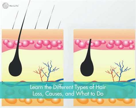 The Types Of Hair Loss How To Prevent Or Stop It And Remedies Hair La Vie