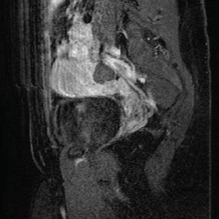 Pelvic Magnetic Resonance Imaging Showing The Following A Sagittal