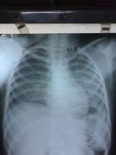 Chest X Ray Miliary Tb