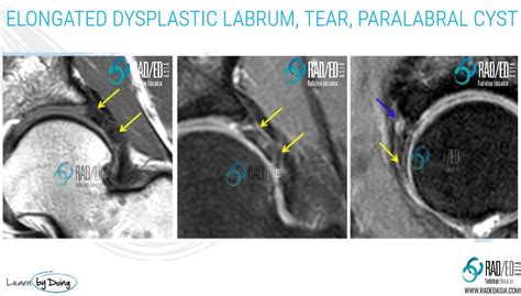 Hip Dysplastic Labrum Mri Acetabular Labrum More Than Just Tears Part