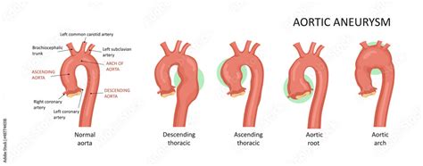 Types Of Aortic Aneurysms Root Ascending Descendingarch Stock