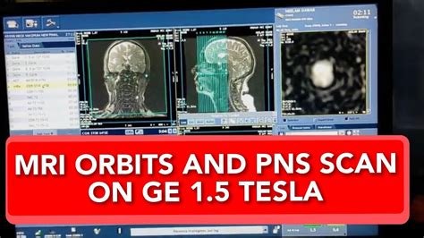 Orbits And Pns Mri Scan Protocol Positioning And Planning Live Demo