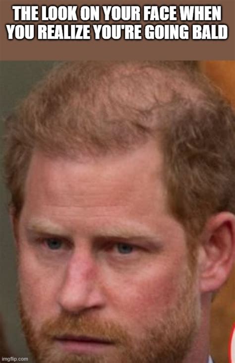 Prince Harry Going Bald Imgflip