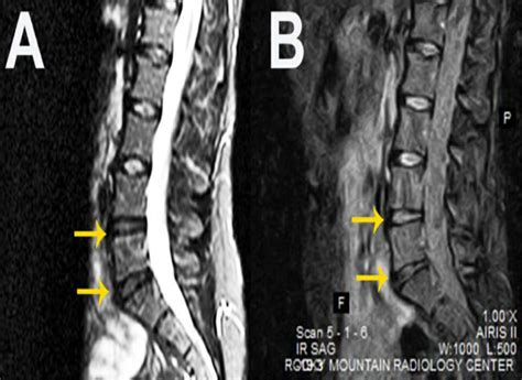 Lower Back Pain - StemCures