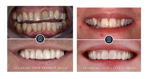 Combining Cosmetic Dentistry Procedures For A Complete Smile Makeover Emedicodiary