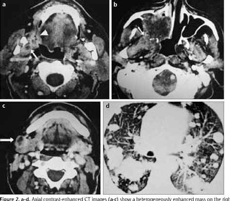 Figure 2 From Carcinoma Ex Pleomorphic Adenoma Of The Minor Salivary Gland With Pulmonary