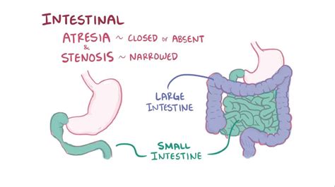 Apple Peel Atresia Usmle