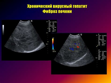 Ультразвуковая диагностика диффузных заболеваний печени - online ...