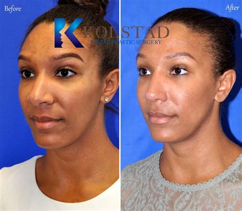 African American Wide Nose Surgery 15 | Dr. Kolstad - San Diego Facial ...