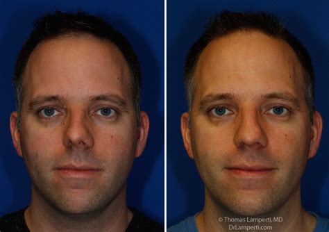 Crooked Nose Rhinoplasty In Seattle Rhinoplasty Surgeon