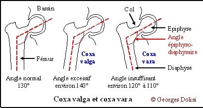 Coxa valga ~ Anatomy for MSP