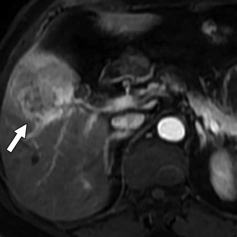 Variant Hepatocellular Carcinoma Subtypes According To The 2019 Who Classification An Imaging