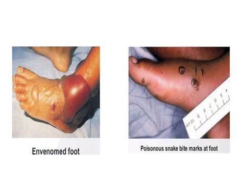 Snake Bite Asv Protocols And Management Antisnake Venom Ppt