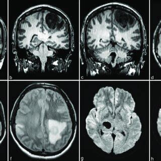 skull magnetic resonance imaging mri december