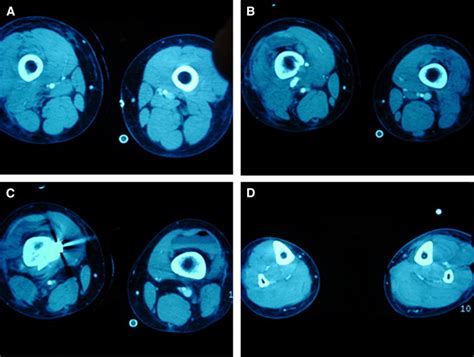 Computed Tomographic Angiography In Pediatric Blunt Traumatic Vascular