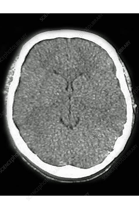 Cerebral Edema Ct Scan Stock Image C0365761 Science Photo Library