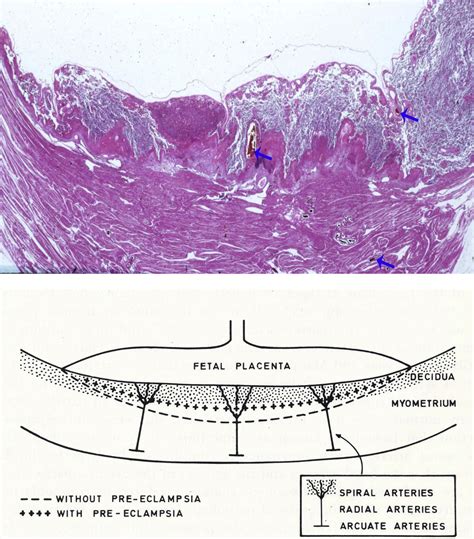 Placental Bed Research I The Placental Bed From Spiral Arteries