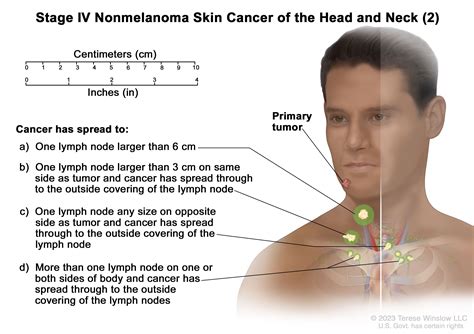 Skin Cancer Treatment - NCI