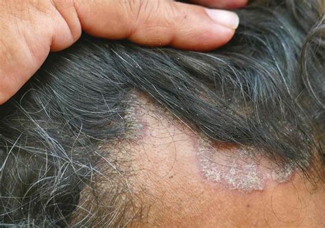 Dandruff Vs Seborrheic Dermatitis