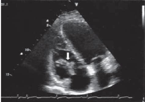 Two Dimensional Transthoracic Echocardiogram Shows The Download