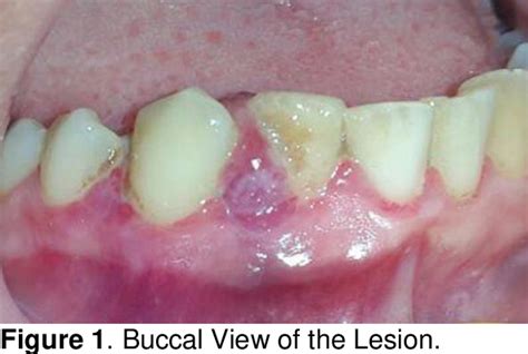 PDF Nonsurgical Management Of Rapidly Recurrent Gingival Pyogenic