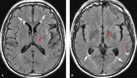 Periventricular White Matter Disease Differential Diagnosis - Pregnant ...