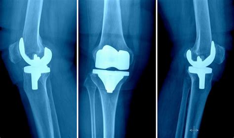 Best Knee Replacement surgeons in Hyderabad