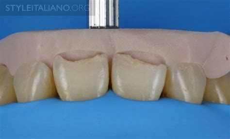 Step By Step For Class IV Restorations