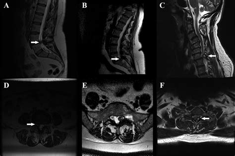 Spinal Synovial Cysts A Case Series And Current Treatment Options Journal Of Clinical