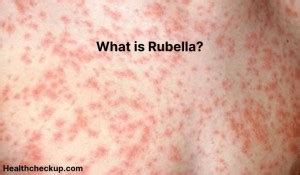 Rubella - Symptoms, Diagnosis, Treatment, Prevention