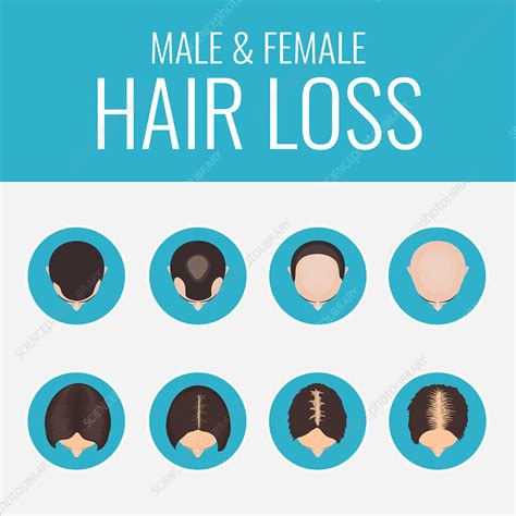 Female and male pattern alopecia, illustration - Stock Image - F034 ...