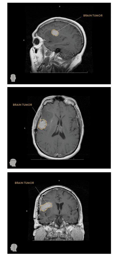 Cat Scan Brain Tumor