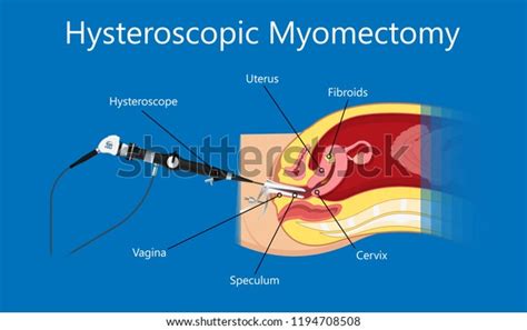 Laparoscopic Hysterectomy Medical Surgical Treat Cervix Stock Vector