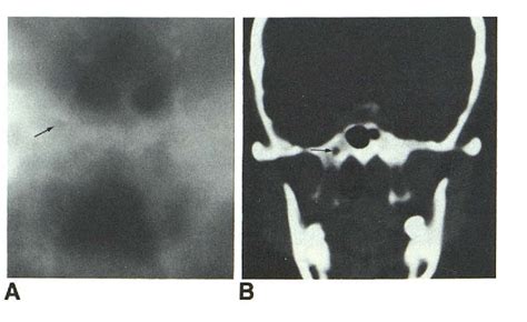 Figure 12 from pathologic findings. The radiology of the pterygoid ...