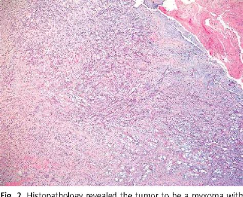 Figure 2 From Left Atrial Appendage Mass Is It Always A Thrombus