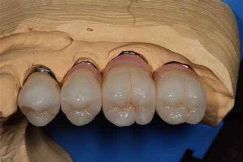 Straumann® Bone Level Implant Custom Hybrid Coloured Zirconia