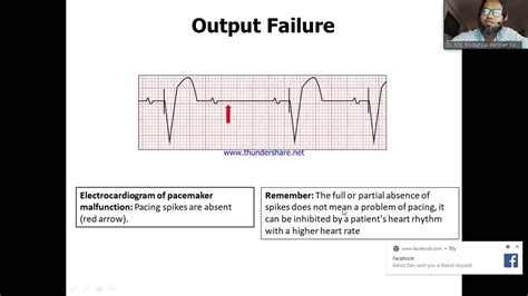 Pacemaker Malfunction And Follow Up By Dr Md Mustafizur Rahman Sir