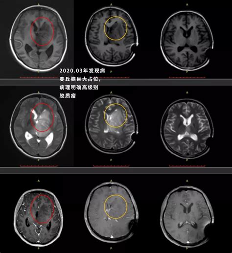 丘脑胶质瘤较佳的治疗效果可以怎样？6个成功治疗故事告诉你 Inc 国际神经外科医生集团