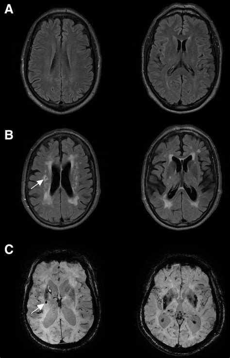 Cerebral Small Vessel Disease Hypertension And Vascular Contributions