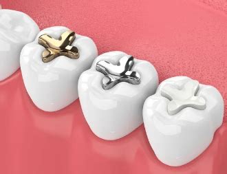 Obturaciones Dentales Una Gu A Completa Asisa Dental