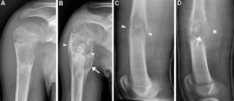 Osteosarcoma Radiology