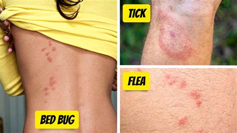 What Bit Me How To Identify The Most Common Bug Bites Youtube