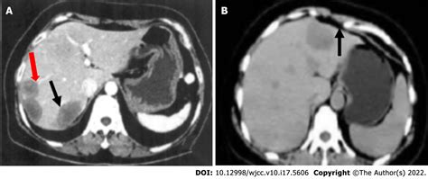 Hepatic Epithelioid Hemangioendothelioma Clinical Characteristics