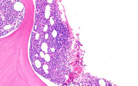 Pathology Outlines Lymphoid Aggregates Benign