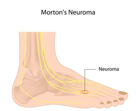 Neuroma Surgery - Foot & Ankle Institute of the West