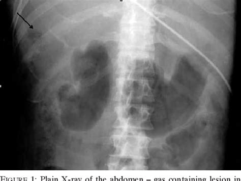 Figure 1 From Intravascular Haemolysis And Septicaemia Due To